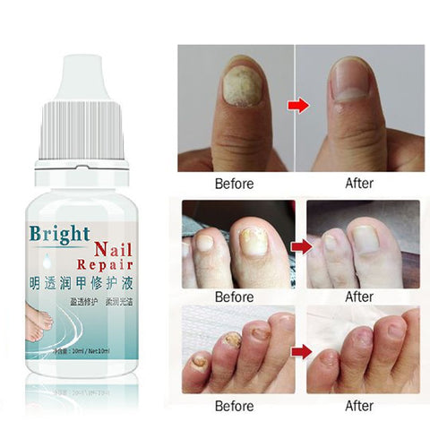 10ML Fungal Nail Treatment Essence Nail Foot Whitening Toe Nail Fungus Removal Feet Care Nail Gel for Onychomycosis  TSLM2